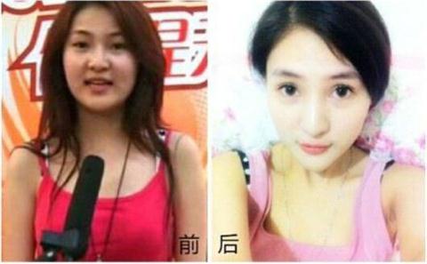 郭美美整容过程曝光 郭美美整容前后照片对比(图)